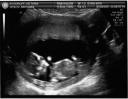 Ultrasound2