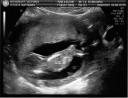 Ultrasound3