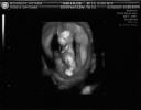 3D Ultrasound