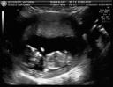 Ultrasound5